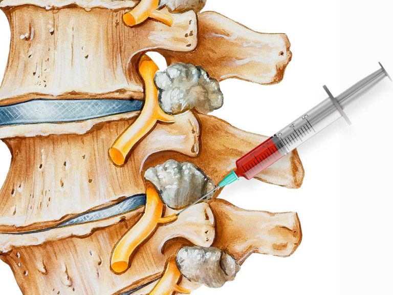 Medial Branch Blocks – Janerich Pain Specialists